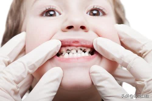 [补牙一般能管多久时间] 补牙一般能管多长时间